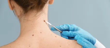 Doctor examining mole on skin