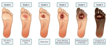 diabetic foot infographic